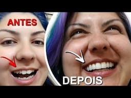 Lentes de Contato nos Dentes Olha No Que Deu (Transformação, Sorriso, Antes e Depois)