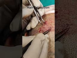 Hair Transplantation for Increasing Hair Density!!