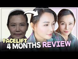 4 months Post-Surgery Result | NANA Plastic Surgery Korea | Natural Results! ✨😊