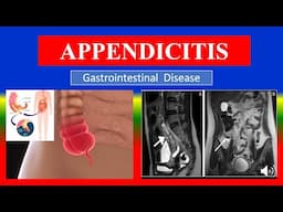 APPENDICITIS - Definition, types, causes, pathophysiology, symptoms , diagnoses , medicine