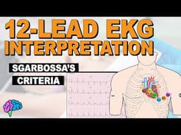 Sgarbossa's Criteria - HOW TO Identify AMI with LBBB on 12-lead EKG