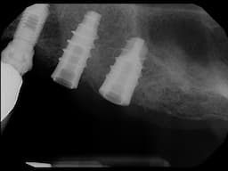 Implant Rescue of an Unknown Brand