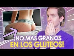 COMO CURAR los GRANOS EN GLÚTEOS Y PIERNAS - Foliculitis: qué es y cómo tratarla