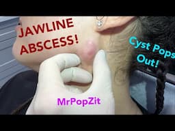 Jawline abscessed cyst. I push and it pops out on to my hand! Pressure relief!