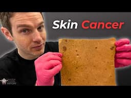 When Skin Cancer Becomes Deadly