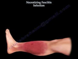 Necrotizing Fasciitis: Early Diagnosis and Treatment of Flesh-Eating Disease