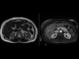 Renal Oncocytoma