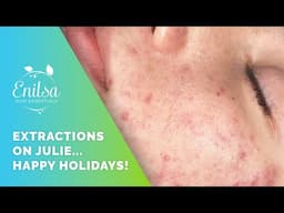 Happy Holidays! Blackhead extractions on our dear friend Julie 🥰