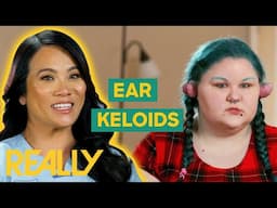 Dr. Lee Helps Cosplayer Remove Huge Keloids From Her Ears! | Dr. Pimple Popper