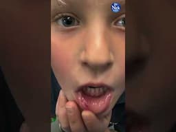 LASER Excisonal BIOPSY on a 6 Year Old! #lightwalker #laser #dentist #dentistry