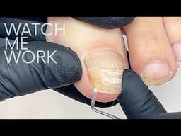 Fixing a very badly cracked toenail with gel  [Pedicure Part 1]