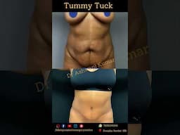 Tummy Tuck Results at 5 months