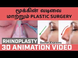 மூக்கின் வடிவை மாற்றும் பிளாஸ்டிக் அறுவை சிகிச்சை 3D animation video for Rhinoplasty.