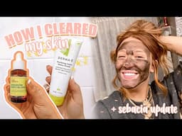 How I Cleared My Skin + the Best Products for Adult Acne | Cicily Boone