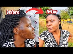 My Simple Skin Care Routine In My African Village//Acne Control!!