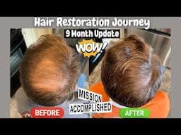 Hair Regrowth Journey - 9 Month Update - Mission Accomplished?