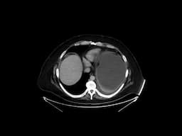 Gastric outlet obstruction