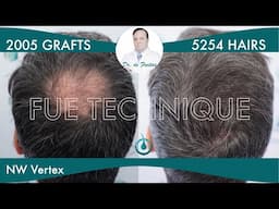 Hair Graft Technique FUE - 2005 Grafts (5254 Hairs) - Dr. Rafael de Freitas