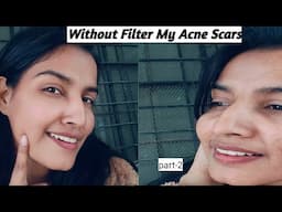 Without Filter My Acne Scars ||क्या मेरे चेहरे पे गड्ढे फिर से दिखने लगे है ? मेरा चेहरा ऐसा क्यों?