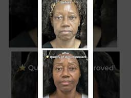 SCULPTRA FACELIFT - Incredible Results without Surgery! #sculptra