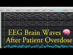 EEG Brain Waves After an Overdose