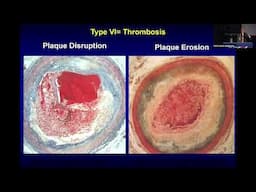 Pedro R  Moreno, MD   CCC2023 Cardiology Board Review 2024 Basic Concepts in Atherosclerosis