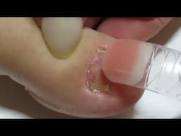 Toenail Transformation Using  (Dual Forms ) Polygel / Natural Builder Gel AMAZING Transformation