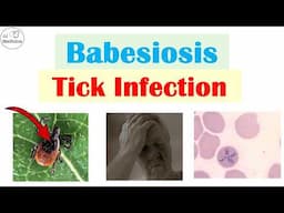 Babesiosis (Infection From Tick Bite) | Pathophysiology, Symptoms, Diagnosis, Treatment