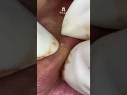 Big Cystic Acne Blackheads Extraction Blackheads & Milia, Whiteheads Removal Pimple Popping #shorts