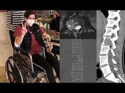 I had a one-in-a-million spinal bone tumor