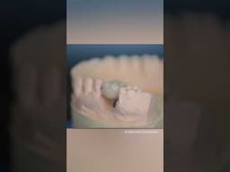 Tooth Implant Crown (DENTAL PHOTOGRAPHY)