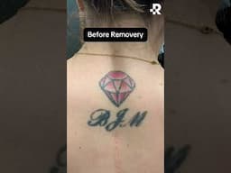 Valentine’s Day Sale: Get $214 off tattoo removal for old relationship tattoos❤️‍🩹