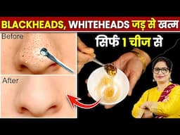 सिर्फ 15 मिनट में Blackheads, Whiteheads, Open Pores, Unwanted Facial Hair को जड़ से हटाए | Face Mask