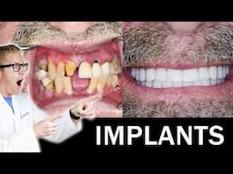 Full IMPLANT DENTURE ALL-ON-4 Procedure! 😁 Teeth-In-A-Day, Fixed Permanent Hybrid - Before & After