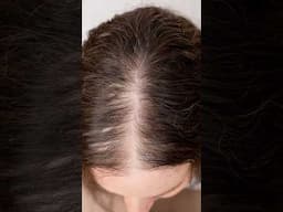 The Different Causes of Hair Loss in Women #femalehairloss