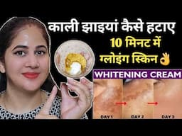 कितनी भी पुरानी झाइयां, pigmentation जड़ से खत्म करें 100% रिजल्ट👌 how to remove pigmentation