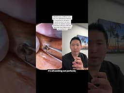 Dermatologist Reacts: Dilated Pore of Winer and Ingrown Hair Extraction