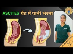 Ascites in hindi | ascites treatment | Ascites examination |