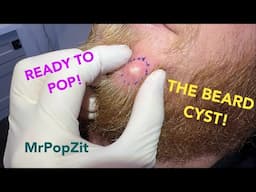 The bearded cyst!Increasing in size and pressure,it was time to go!See the suture removal at the end