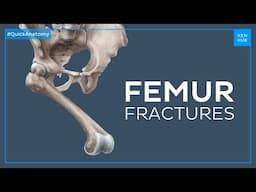 What happens when you fracture your femur - Quick Anatomy | Kenhub