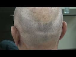 Hair Loss Treatment for Men | [Type of transplant] (# Hair grafts)