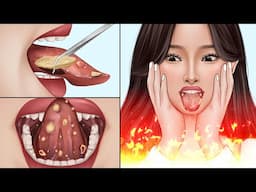 ASMR Canker sores cause of mouth ulcer treatment | Tonsil stone removal animation