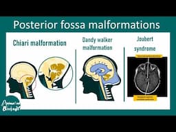 Posterior Fossa malformations | Neurology and Radiology of Posterior Fossa malformations