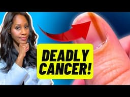 SUBUNGAL MELANOMA: The Deadly Cancer You Should NEVER IGNORE! A Doctor Explains