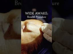 WIDE AWAKE PLASTIC SURGERY : Brow Lift in 2025￼