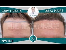 Hair Graft Technique FUE Grafts 2389 (5826 Hairs)