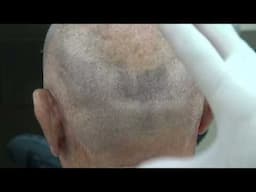 This video Dr. Diep show example of an FUE leaner scar also call the "strip harvesting"