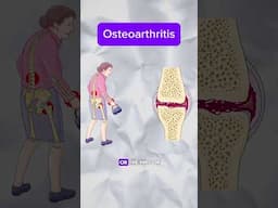 Rheumatoid vs osteoarthritis: Part 1