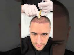 PRP injections post hair transplant operation 💉 #hairtransplant #prp #viralvideo