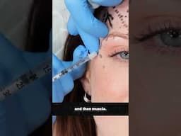 Botox brow lift injection depth